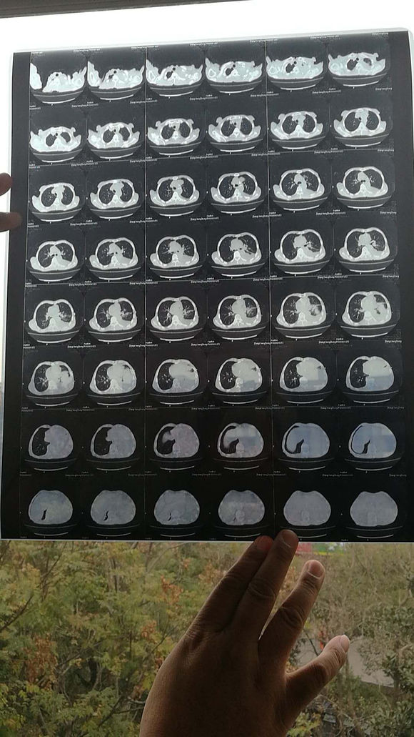 爷爷被查出肺癌，一时不能接受。来贴吧看了许久