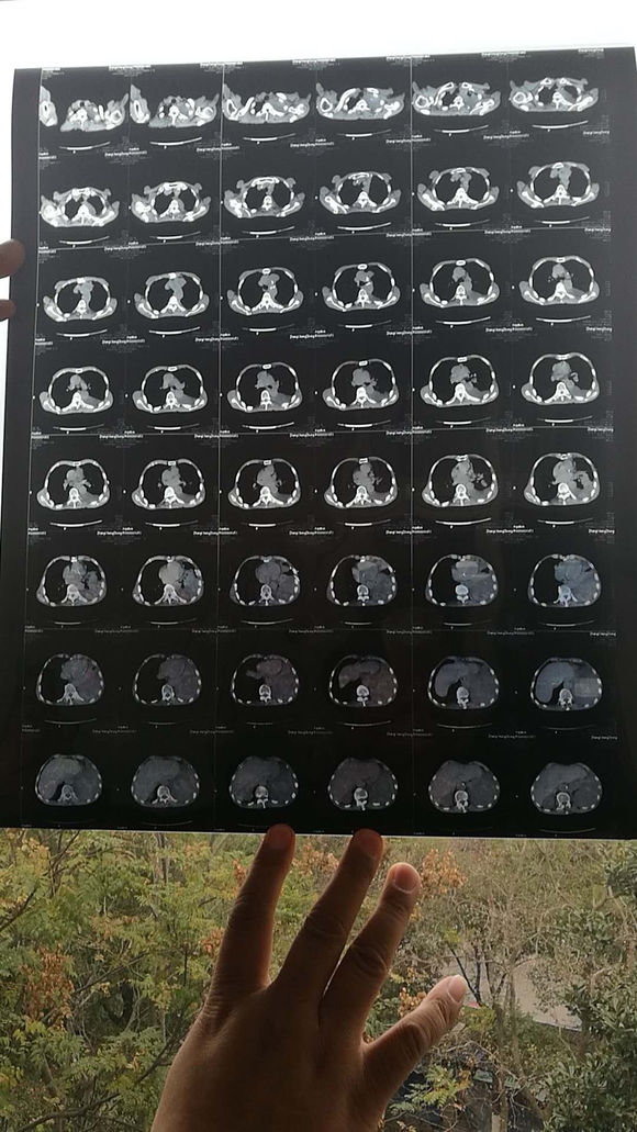 爷爷被查出肺癌，一时不能接受。来贴吧看了许久