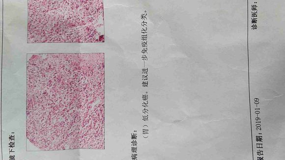 宫颈癌，胃癌，真是验证了一句话，福无双至祸不单行