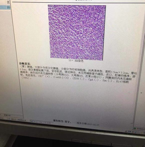 我妈妈胃癌已手术，懂的帮看下这是几期？