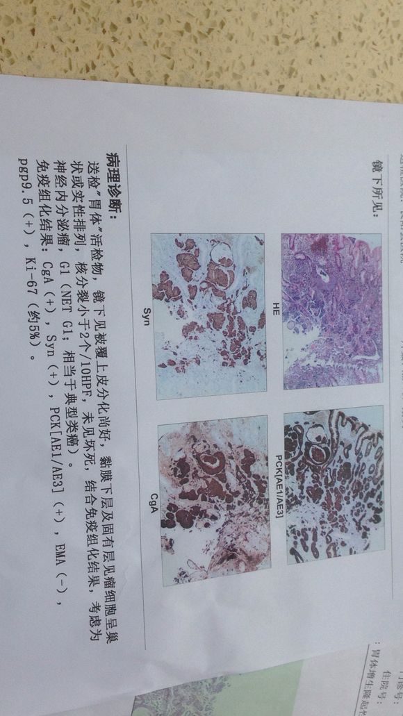 我妈妈去年做的胃切除手术，切了4分之三的胃