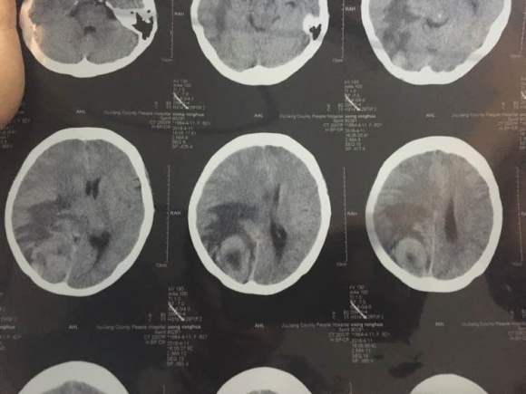 有人会看片子吗？帮我看看这情况怎么办