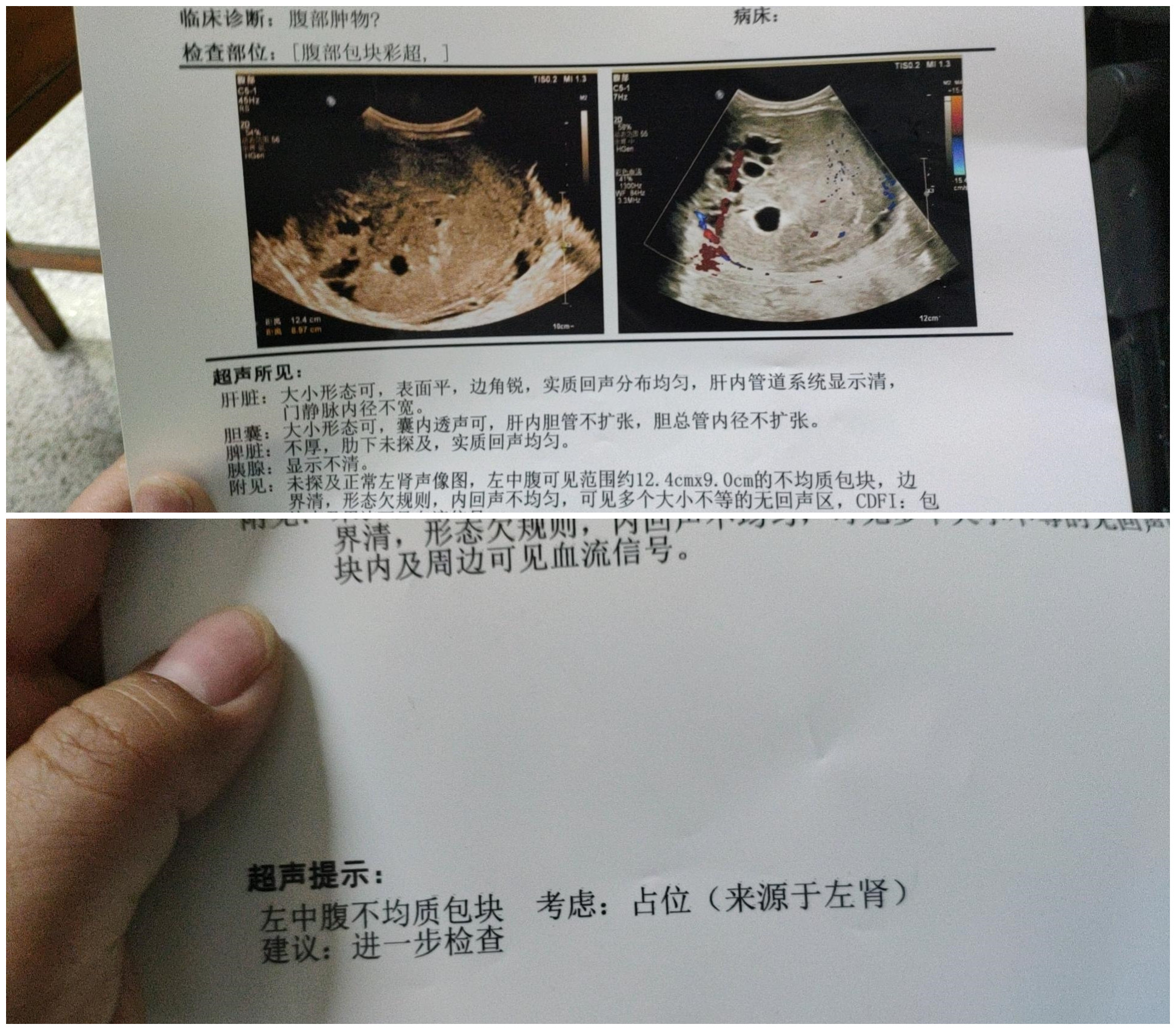 孩子一岁四个月，肾母细胞瘤