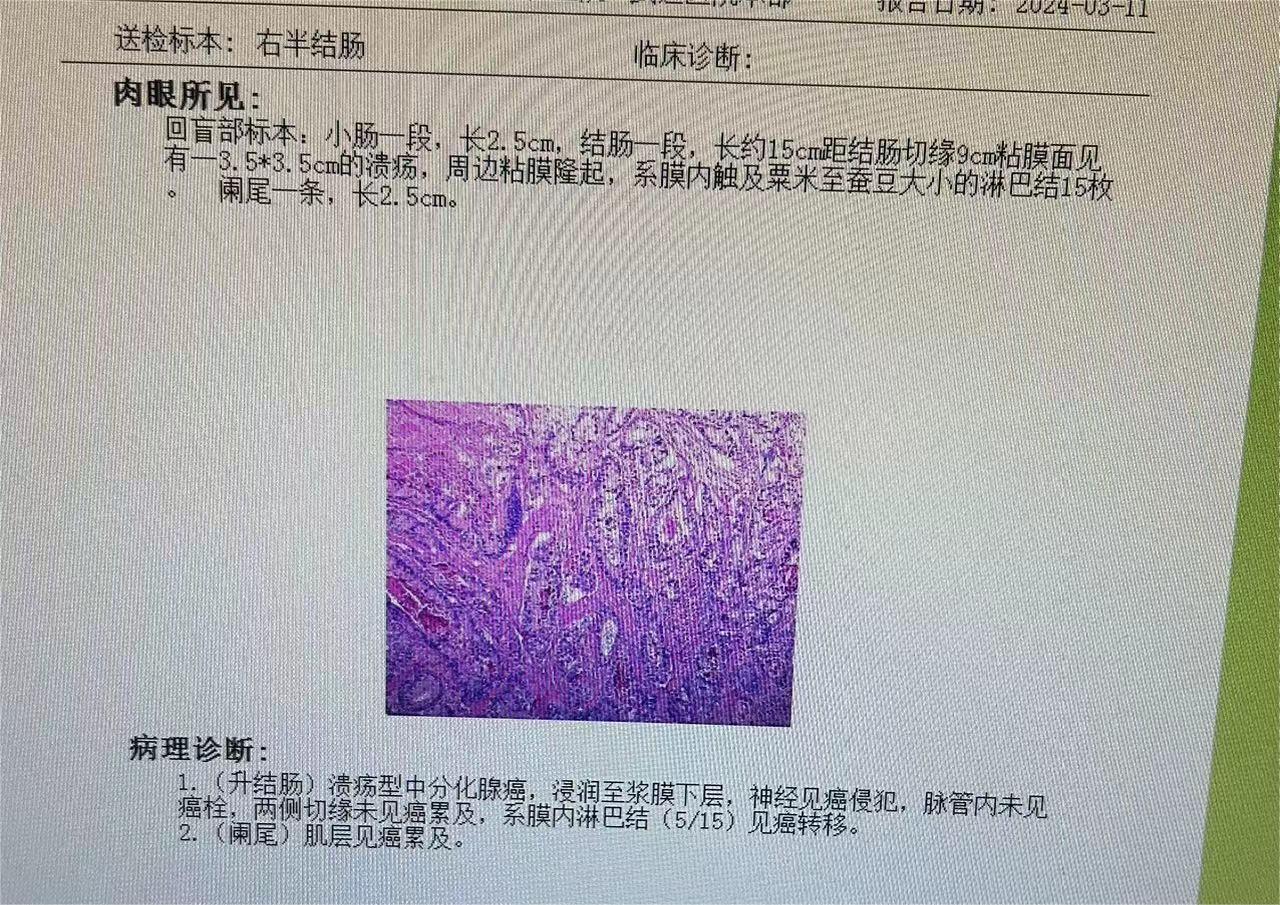 结肠腺癌这样子后续还有必要化疗么