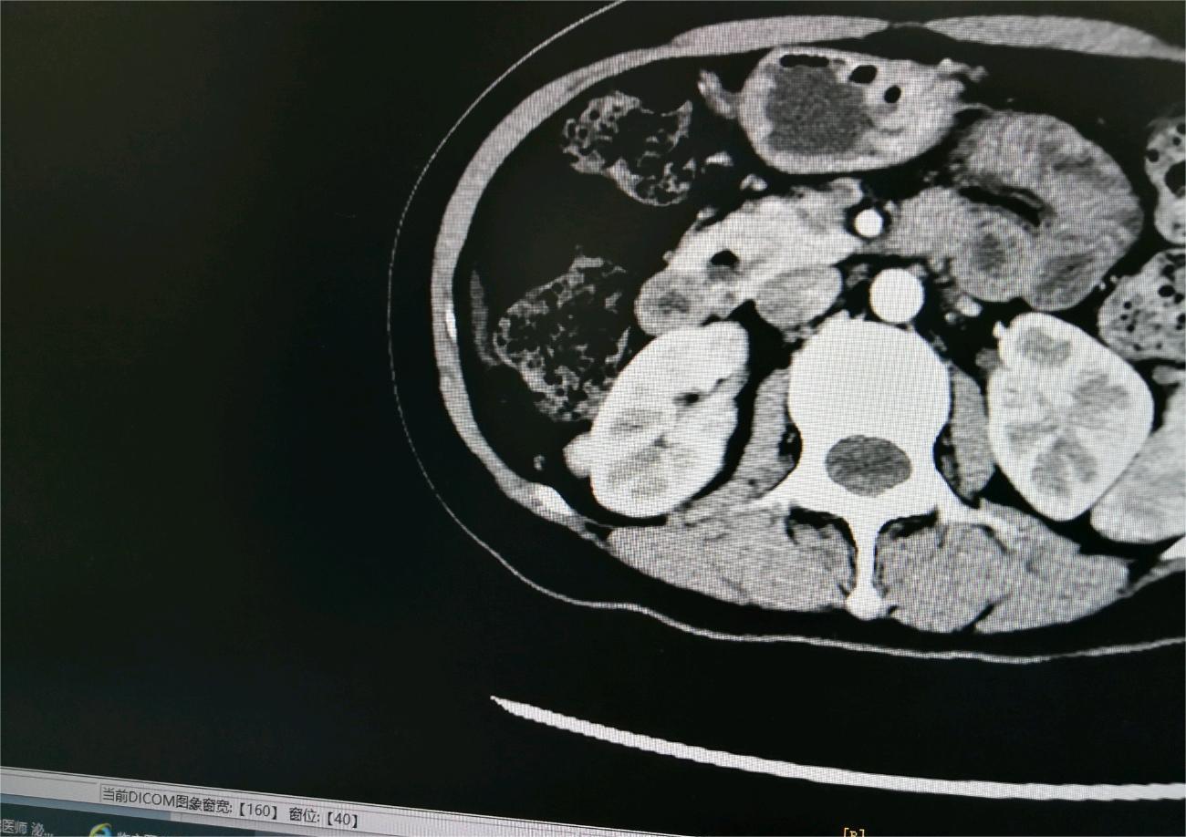 肾脏肿瘤？什么类型？